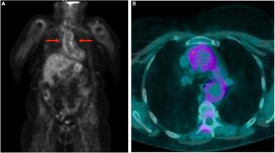 Use of 18F-fluorodeoxyglucose positron emission tomography-computed tomography in patients affected by polymyalgia rheumatica and persistent increase of acute phase reactants